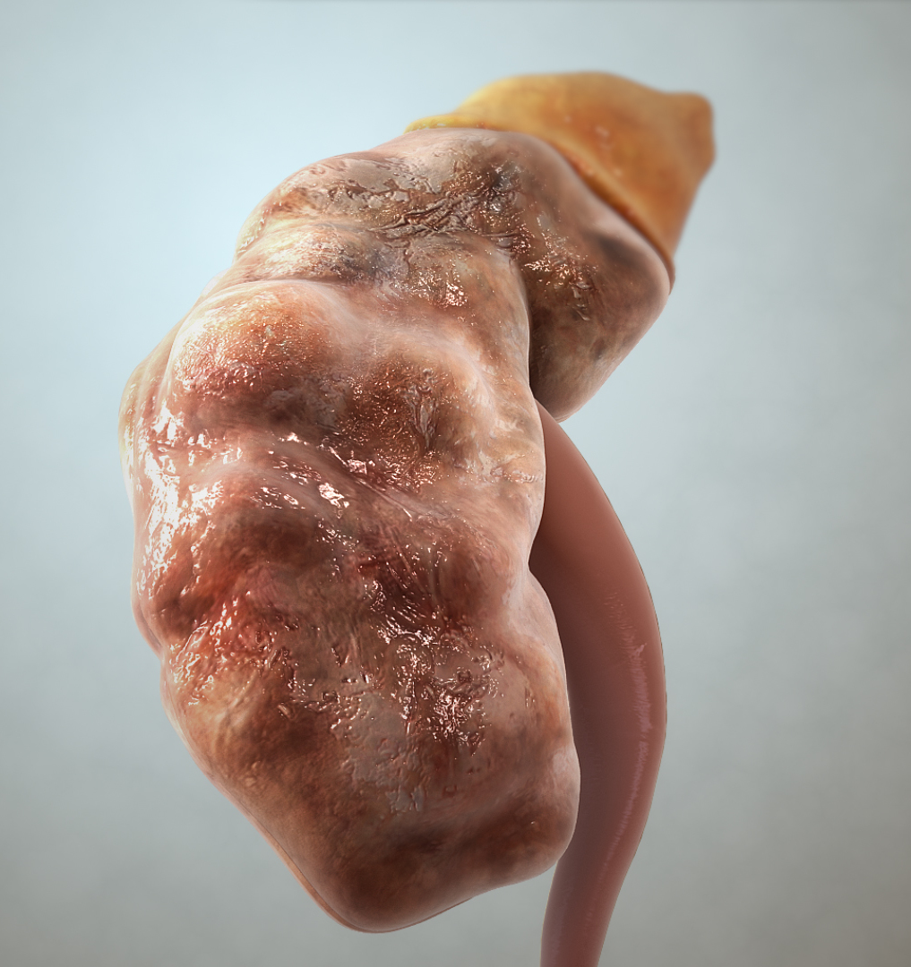 chronic kidney disease